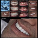 نمونه کار ایمپلت در اصفهان