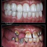 نمونه کار کاشت ایمپلت در اصفهان