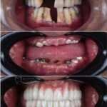 نمونه کار کاشت ایمپلت در اصفهان